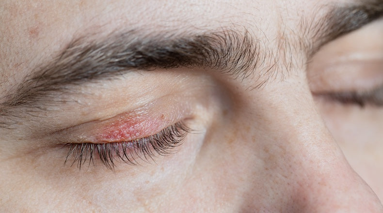 How to Care for Sensitive Skin Around the Eyes