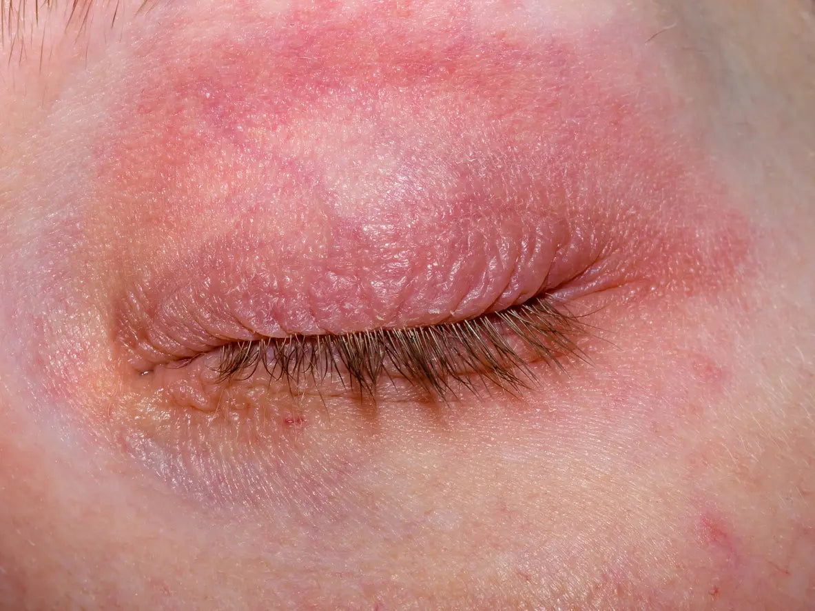 What is Atopy Prone Skin?