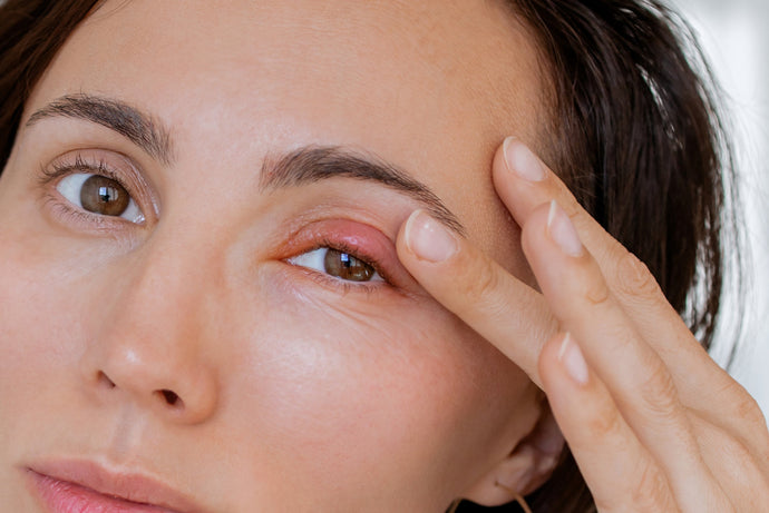Chalazion vs. Stye: What’s the Difference?