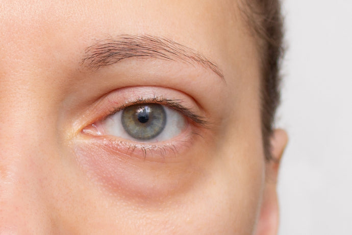 Fed up with Puffy Eyes? Causes, Symptoms & Treatments